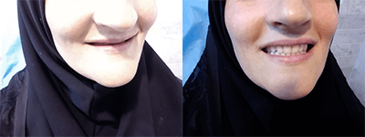 نمونه کارهای ساخت دندان در دندانسازی محلات