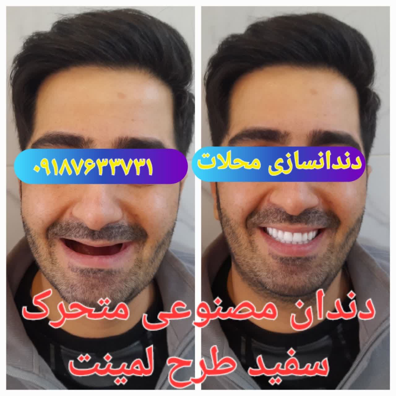 دندانسازی محلات