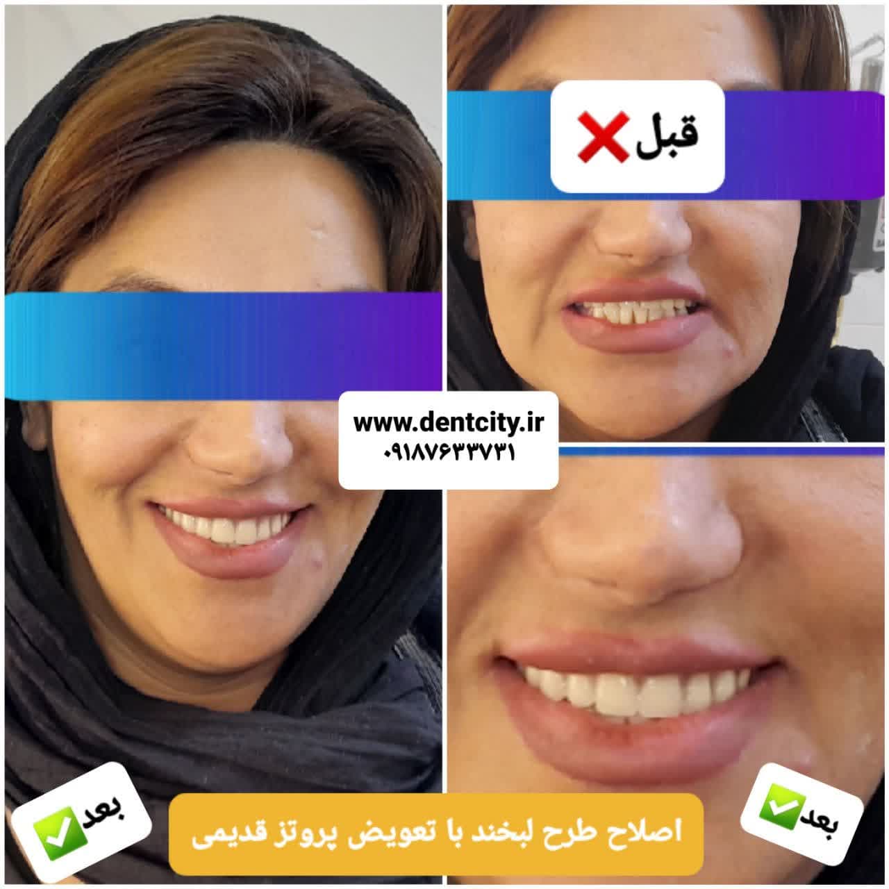 دندانسازی محلات