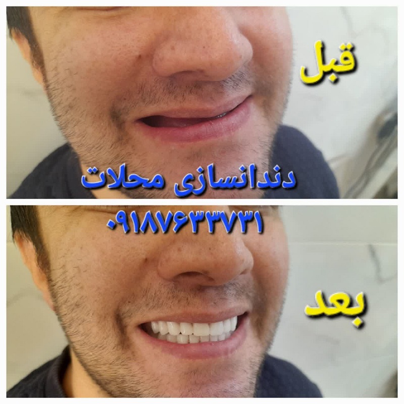 دندان ژله ای محلات