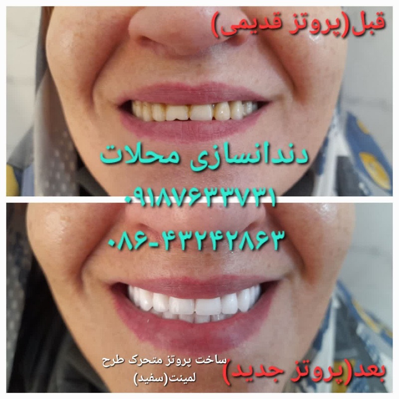دندانسازی محلات