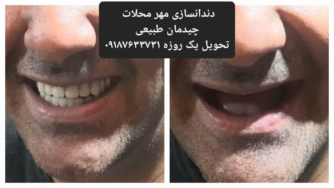 دندانسازی محلات