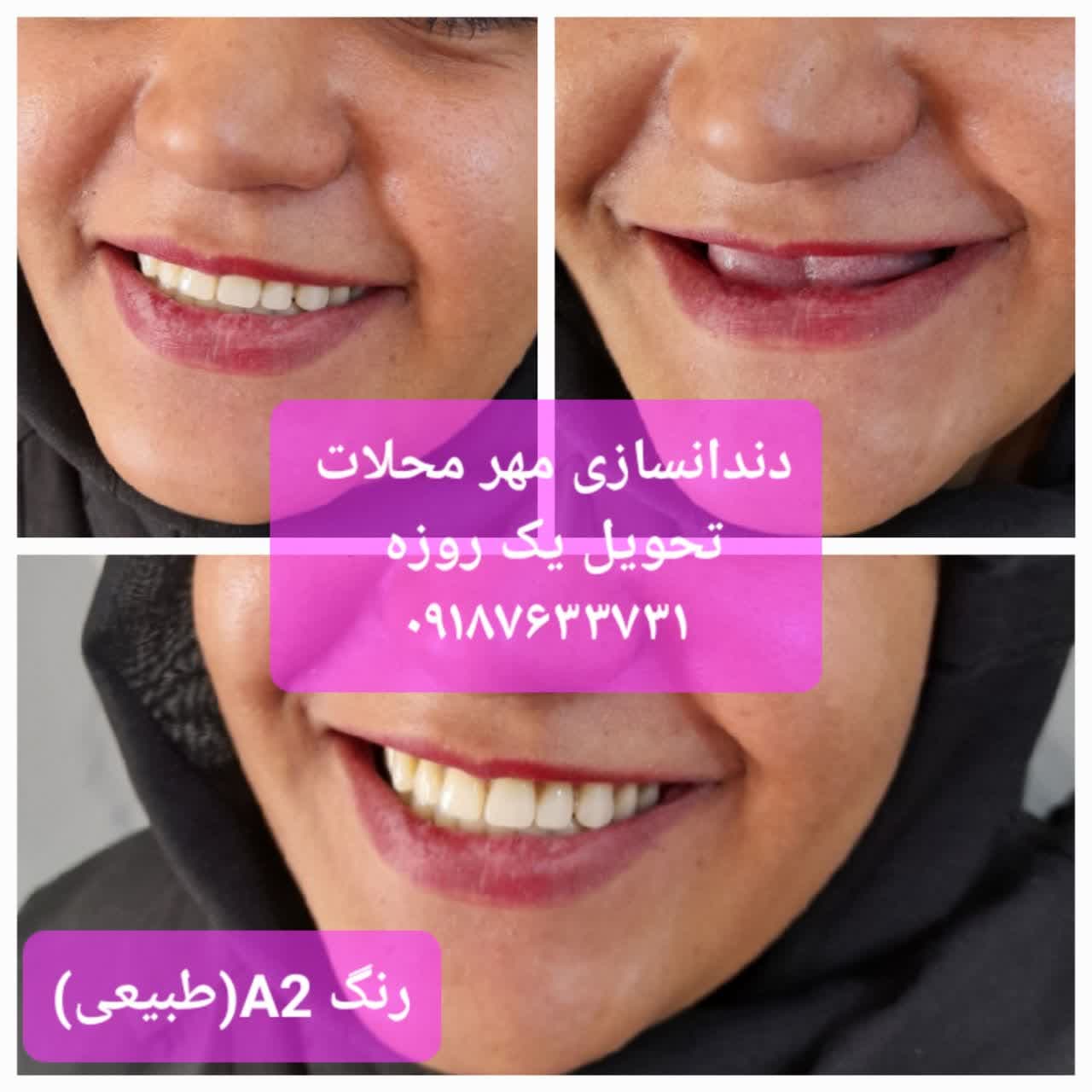دندانسازی محلات
