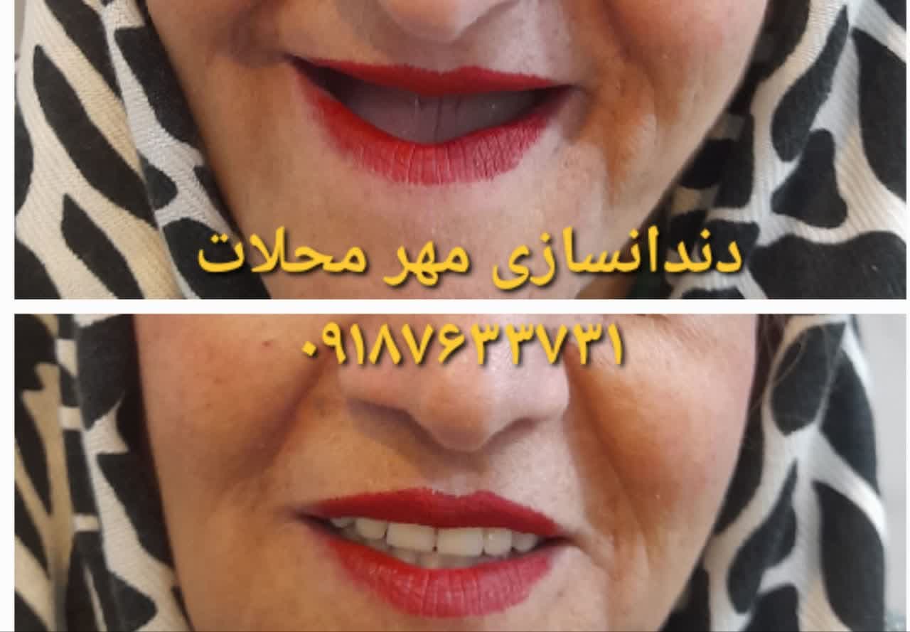 دندانسازی محلات