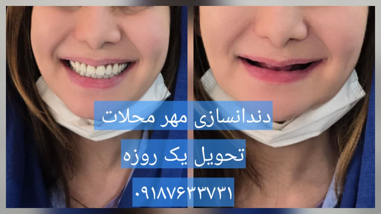 دندان مصنوعی برای افراد جوان