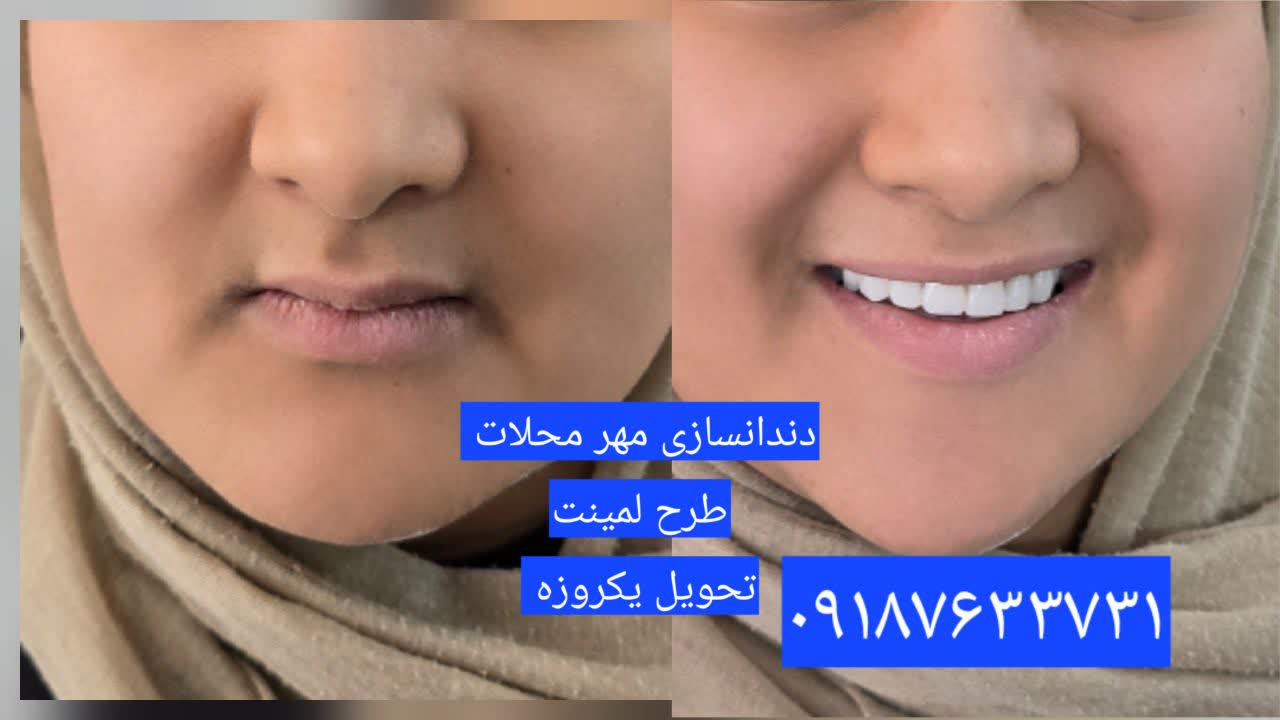 دندانسازی محلات