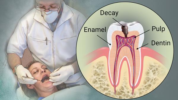 شناخت علل پوسیدگی دندان